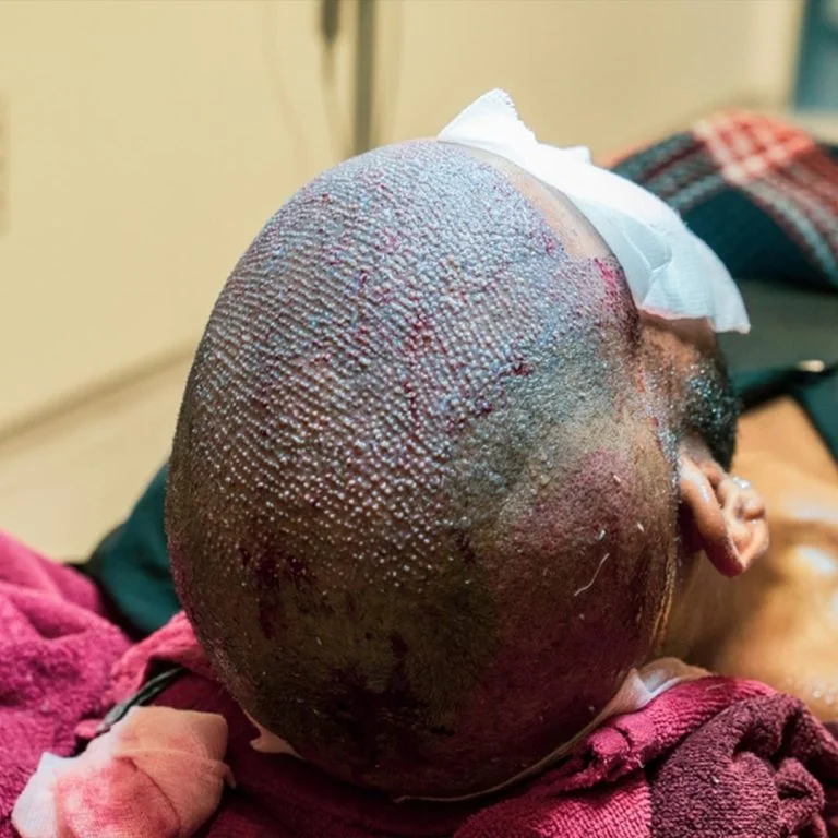 Afro Hair Transplant​