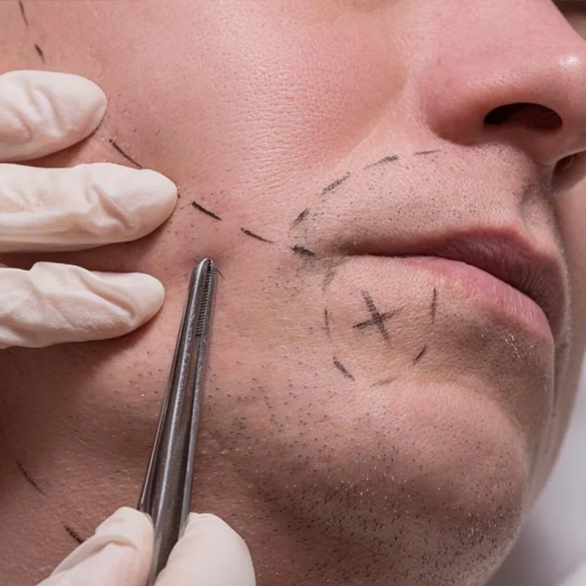 Beard (Facial Hair) Transplant