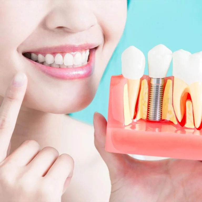 Dental Implant