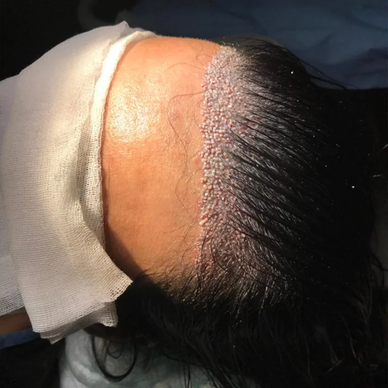 Women’s Hair Transplant
