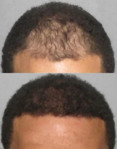 afro hair transplant