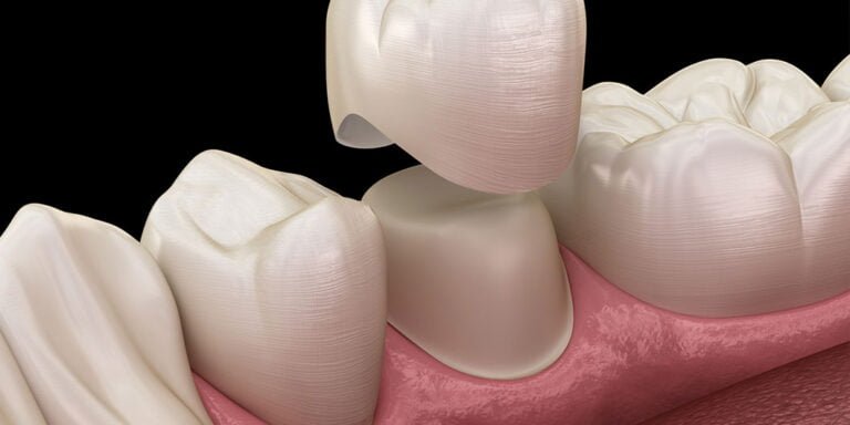 Understanding Zirconium Crown: Benefits and Applications in Dentistry